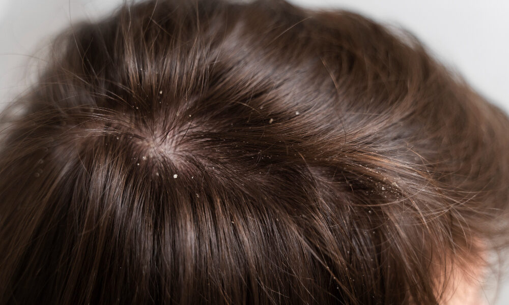 cabelo com caspas