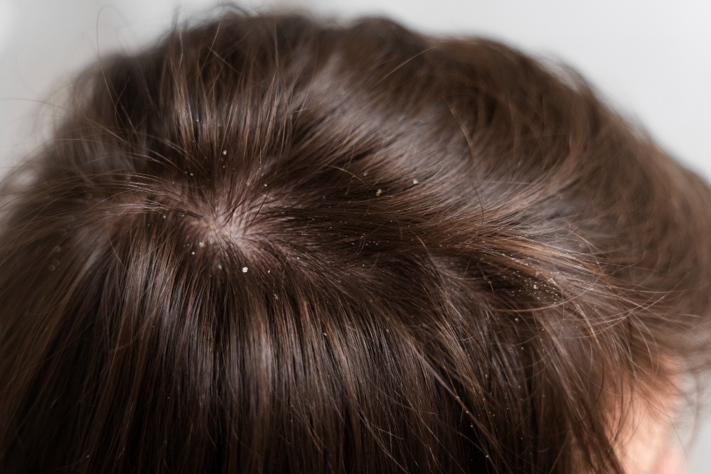 O que causa a caspa e como acabar com as caspas? 4 cabelo com caspas